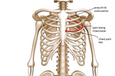 Revbensled låsning, smärta bröstkorg