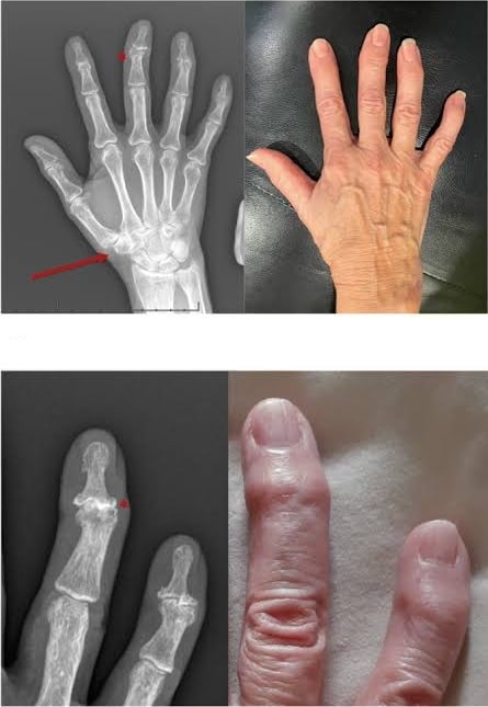 hand med artros