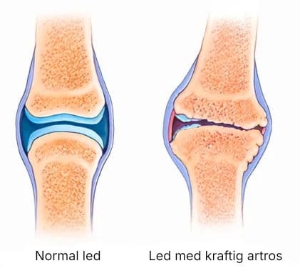 Led med kraftig artros Led med kraftig artros